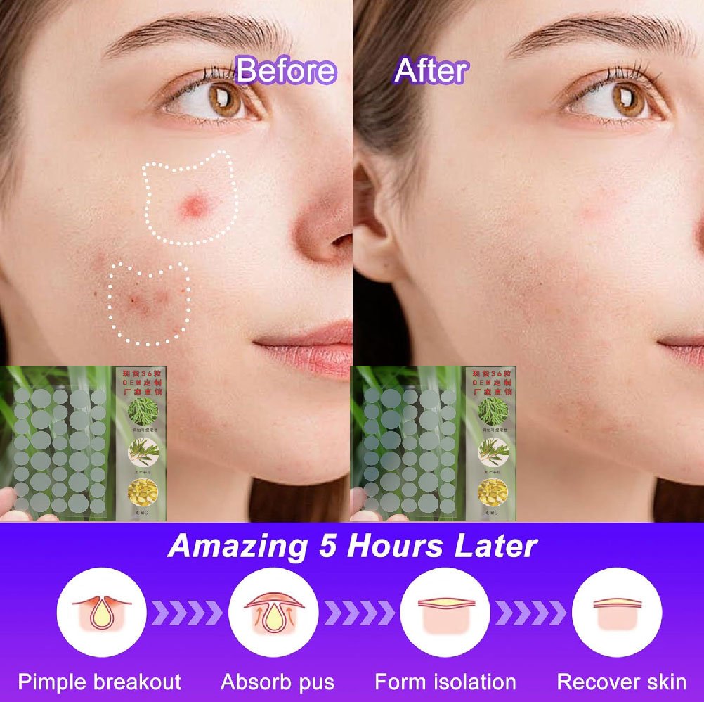 Star-Shaped Acne Patches- 40 Pcs - Image 4